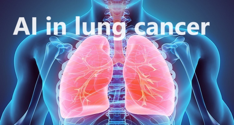 AI-in-lung-cancer.jpg