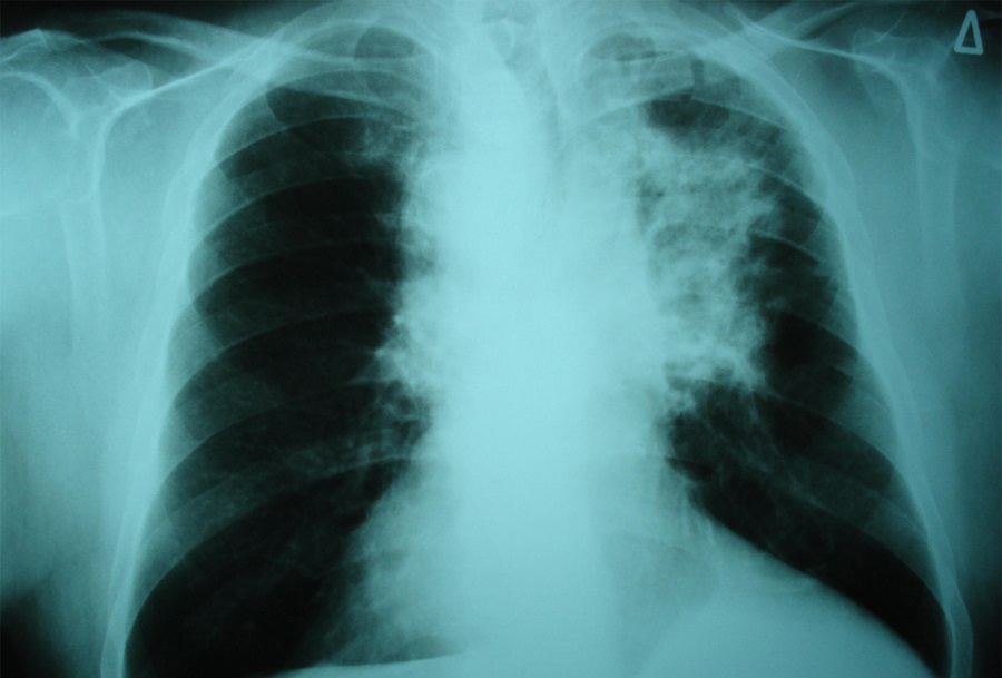 x-ray lung cancer